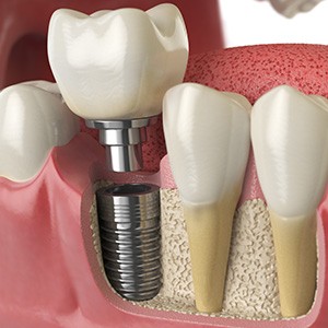 Illustration of a single dental implant in a lower jaw