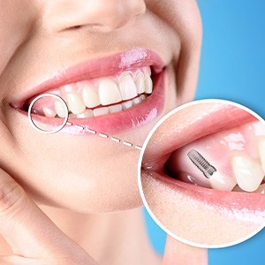 Nose-to-neck view of woman smiling with one tooth indicated as an implant via diagram