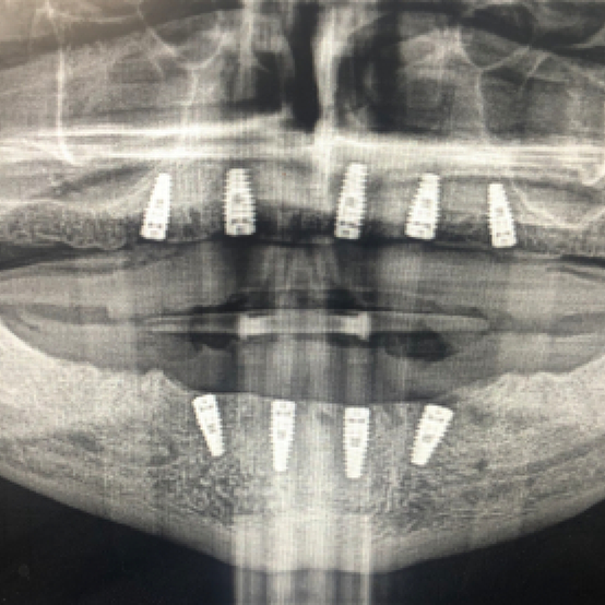 X ray of a person with several dental implants