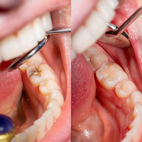 Tooth before and after replacing an old metal filling with a tooth colored filling