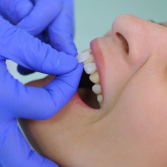 Cosmetic dentist in Jupiter placing a veneer over a tooth