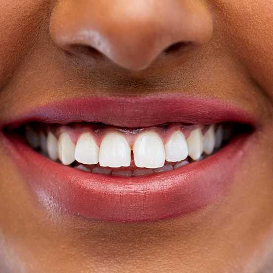 Close up of smile with small gap between two front teeth