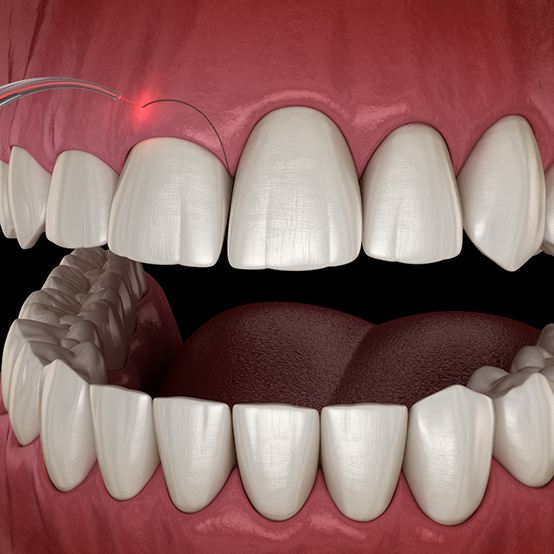 Illustrated dental laser performing gummy smile correction