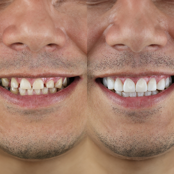 Man smiling before and after treating discolored and gapped teeth