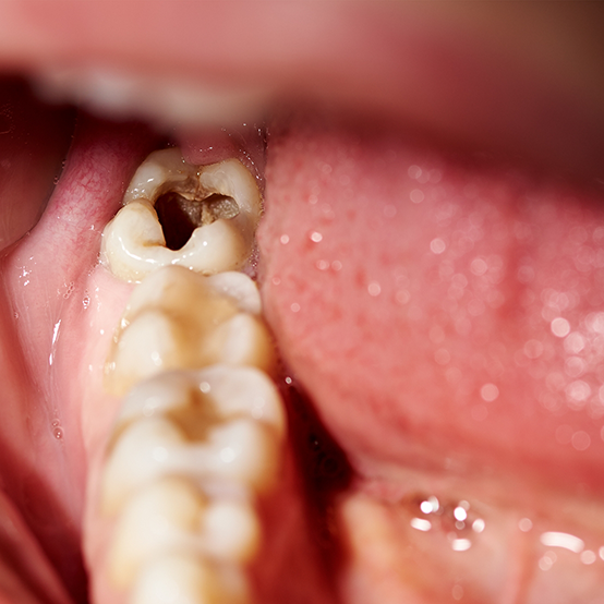 Close up of a decayed tooth