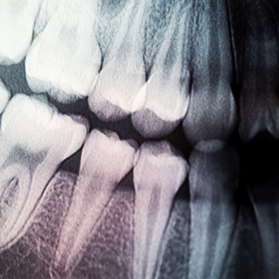 X rays of several teeth