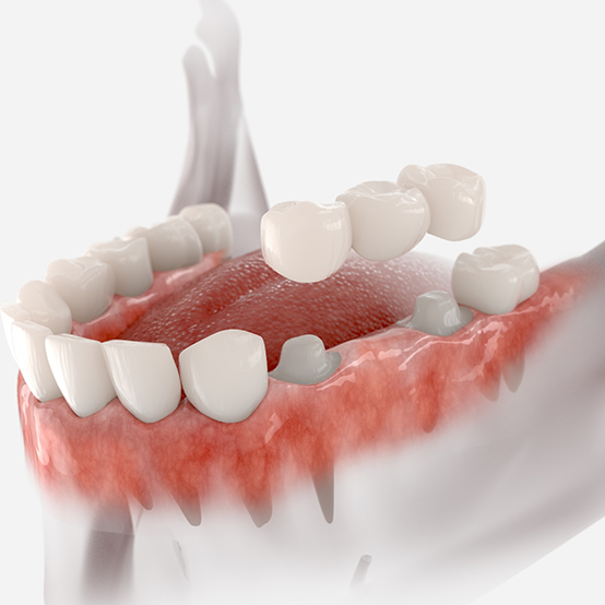 Illustrated dental bridge being fitted to replace missing teeth in Jupiter