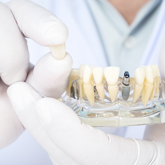 Gloved hand holding a dental crown and a model of the mouth with a dental implant