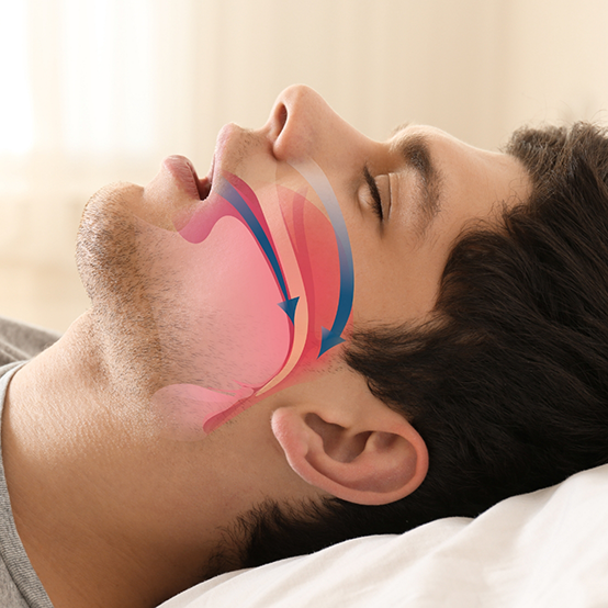 Sleeping person with illustration of blocked airway needing sleep apnea treatment in Jupiter