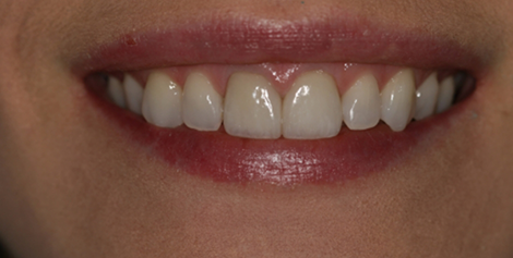 Close up of improved smile after treatment from Jupiter dentists