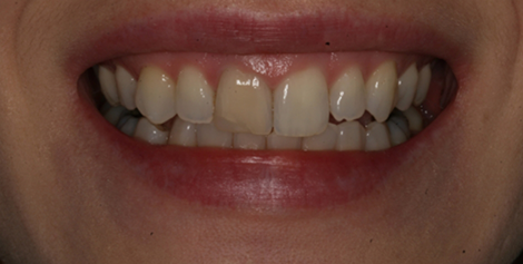 Close up of smile with slightly crooked and chipped teeth