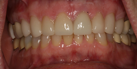 Mouth with brighter teeth after dental treatment