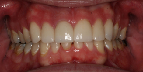 Close up of mouth after fixing gapped teeth