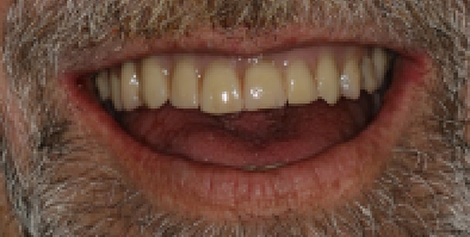 Close up of man smiling with full row of upper teeth