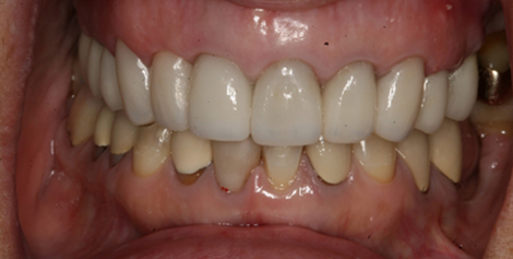 Close up of mouth with new dental restorations