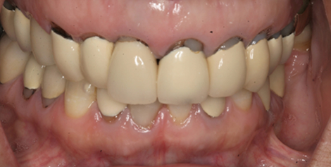 Close up of mouth with several old gray dental restorations