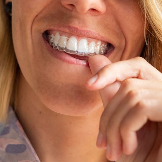 Woman placing an Invisalign aligner over her teeth