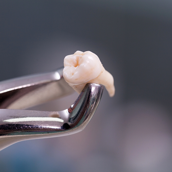 Dental clasp holding an extracted tooth after tooth extraction in Jupiter